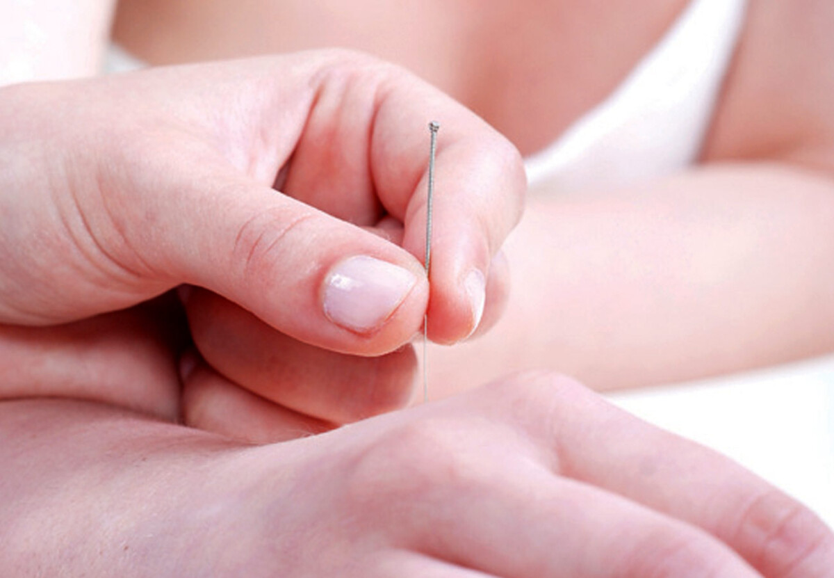 Wheaton IL Acupuncture Services