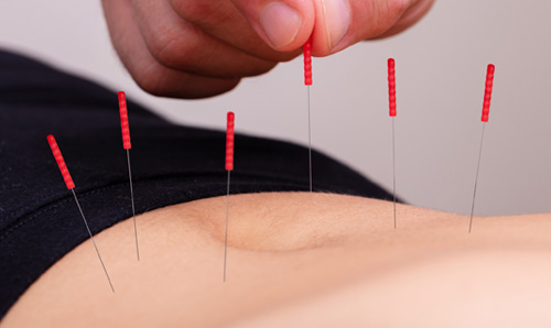 Acupuncture and Alternative Medicine